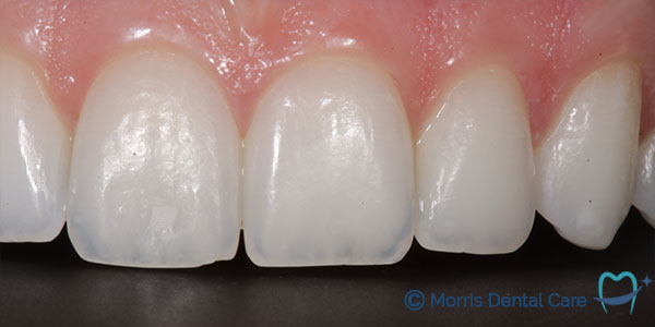 Using ICON - a no-drill reduce the appearance of the white spots without removing any healthy tooth structure.